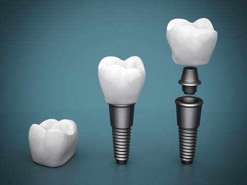 Имплантация зубов «All-on-6» – новая улыбка в клинике «32 Дент»