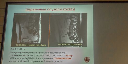 Доказали высокую эффективность стереотаксической лучевой терапии в лечении рака
