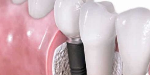 Какие импланты лучше ставить?