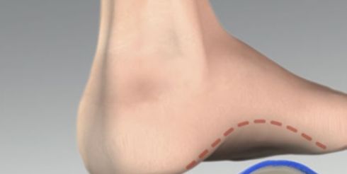 Как подобрать ортопедические стельки при вальгусной деформации стопы