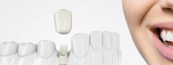 Как выбрать импланты зубов: виды и цены