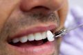Что такое зубные виниры и каковы их разновидности