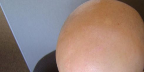 Ученые создали крем от облысения
