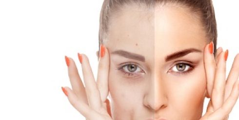 Как выглядит лицо после фотоомоложения?