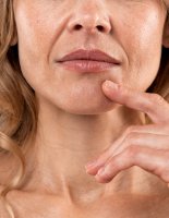 Можно ли устранить глубокие носогубные складки в зрелом возрасте?